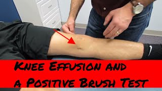 Knee effusion positive brush test and intraarticular knee injury eval [upl. by Bunde71]