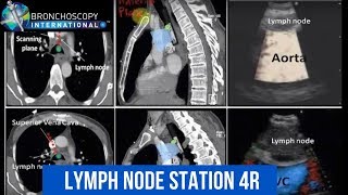 BronchAtlas EBUS Identification Lymph Node Station 4R [upl. by Ola]