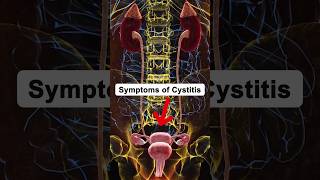 Symptoms of Cystitis cystitis health healthtips shorts [upl. by Hillard]