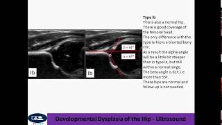 Developmental Dysplasia of the Hip  Ultrasound [upl. by Latsryk]