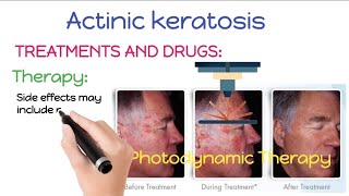 How To Treat and Remove Actinic Keratosis  Actinic Keratosis Treatment And Removal Procedures [upl. by Nirek]