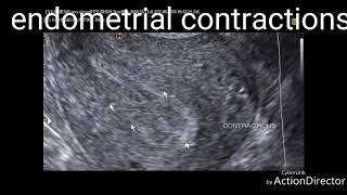 Endometrial contractions ultrasound video [upl. by Nohtanhoj55]