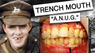 Acute Necrotizing Ulcerative Gingivitis AKA TRENCH MOUTH [upl. by Alene889]