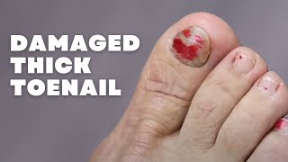 WHAT COULD PREVENT THIS TO KEEP HAPPENING DAMAGED THICK TOENAIL [upl. by Wina762]