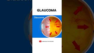 What is Glaucoma 👁️ [upl. by Normac]