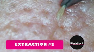 Whitehead and BlackHead RemovalExtraction 2 Reedition [upl. by Etnovad]