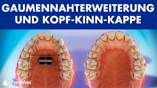 Kieferorthopädie  Gaumennahterweiterung und KopfKinnKappe © [upl. by Olegnaed]