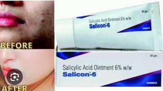 Salicon 6 Ointment Salicylic Acid Ointment 6 ww [upl. by Haimrej]