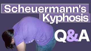 Common Questions About Scheuermanns Kyphosis [upl. by Erline]