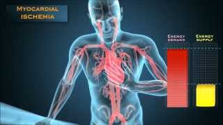 Understanding the energetic mechanisms that cause angina pectoris [upl. by Adnalay]