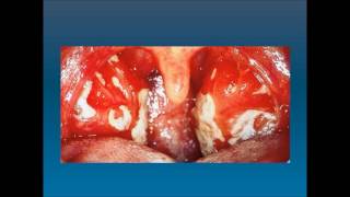 Mononucleosis infecciosa Enfermedad del beso [upl. by Resaec383]