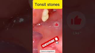 tonsil stones remover small tonsils at home reels trendingshorts reaction [upl. by Olbap]