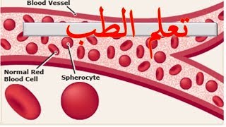 Hereditary spherocytosis [upl. by Ylrac]