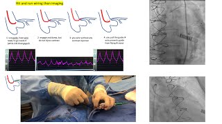 Aortoostial angiography and stenting tips and tricks  case illustrations Elias Hanna [upl. by Osyth296]