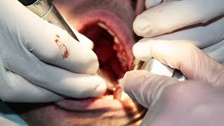 Root Canal Surgery [upl. by Iinden]