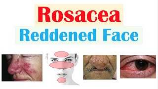 Rosacea Red Lesions on Face  Causes Triggers Types Signs amp Symptoms Diagnosis Treatment [upl. by Edik]