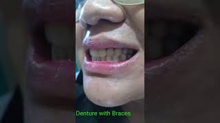 Denture With Braces How You Like That [upl. by Melly]