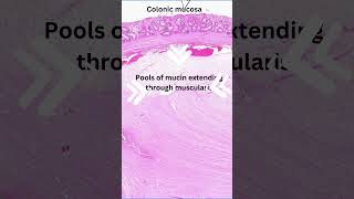 Histology of colitis cystica profunda [upl. by Ilise]