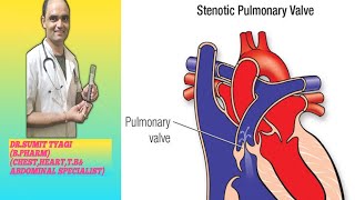 PULMPNARY STENOSIS VALVE BY DRSUMIT TYAGISUMITMEDICALDISPENSARY1 [upl. by Stefa]