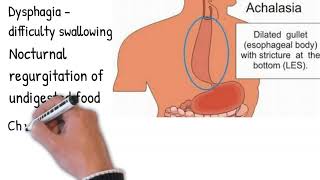 Esophageal achalasia  Symptoms diagnosis and treatment simply and shortly [upl. by Berardo]