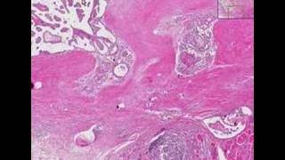 Histopathology ThyroidHashimoto thyroiditis papillary car [upl. by Acinoryt]