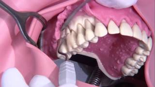 Periodontal surgery Modified Widmann flap [upl. by Adnoral]