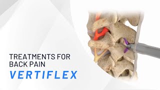 The Vertiflex Procedure  Treatments for Back Pain [upl. by Samy]