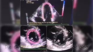 Septal Bounce on Echo in CPC  constrictive pericarditis [upl. by Marianne663]