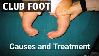 Clubfoot Deformity Clubfoot Physiotherapy How to treat ClubFoot [upl. by Hamrah]