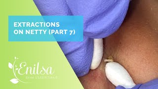 Extracting Blackheads on Netty  Seventh Treatment [upl. by Elbon]