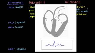 Signs and symptoms of myocarditis and pericarditis [upl. by Thane]