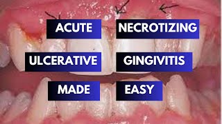 Mastering Acute Necrotizing Ulcerative Gingivitis  All You Need To Know [upl. by Ed630]