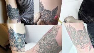 Laser Tattoo Removal Journey  BEFORE amp AFTERS [upl. by Attenov]