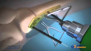 Distal Femoral Osteotomy Animation [upl. by Debora591]