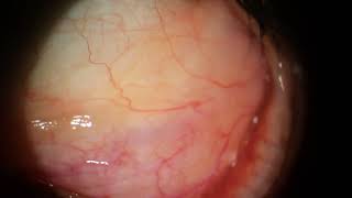 Prolapsed Orbital Fat and Conjunctival Cysts with Concretions [upl. by Benioff]