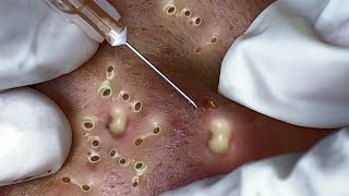 Big Cystic Acne Blackheads Extraction Blackheads amp Milia Whiteheads Removal Pimple Popping 096 [upl. by Dietz]