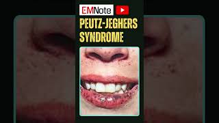 Peutz Jeghers Syndrome [upl. by Nomal]