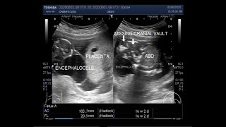 Anencephaly and Encephalocele with a pregnancy of about 16 weeks [upl. by Ahsirek637]