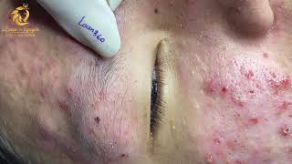 Treatment of acne tablets pustules and blackheads 360  Loan Nguyen [upl. by Llesirg]