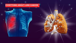 LUNG CANCER SYMPTOMSRISKS FACTORS AND TREATMENT [upl. by Porche]