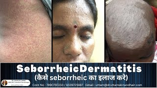 Treatment of Seborrheic Dermatitis Dandruff and Cradle Cap  कैसे डैंड्रुफ़ का इलाज करे  Dr Uttam [upl. by Anerul503]