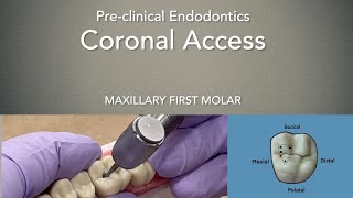 Coronal Access Maxillary First Molar [upl. by Higley]