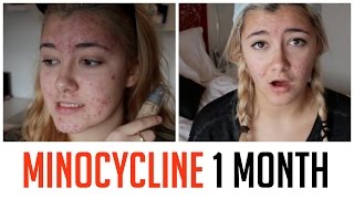 1 MONTH ON MINOCYCLINE UPDATE  HOW I CLEARED MY ACNE [upl. by Haikan]