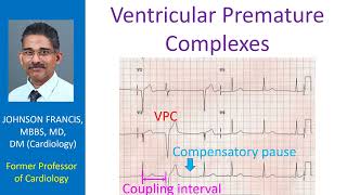 Ventricular Premature Complexes [upl. by Steele]