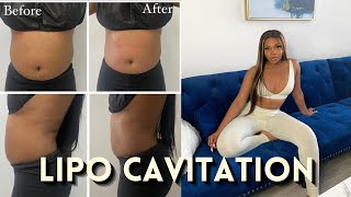 LIPO CAVITATION REVIEW  DOES IT REALLY WORK BEFORE AND AFTER [upl. by Balliett]