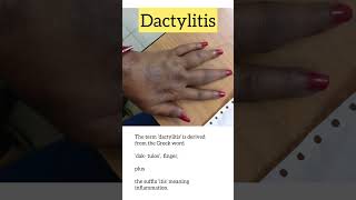 Dactylitis Sausage digits  Psoriasis  Joints disease  Gout  Rheumatology shorts [upl. by Lucey138]