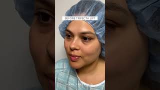 Before amp After Trifecta Lift  Latina Patient  Dr Kami Parsa Beverly Hills [upl. by Albion]